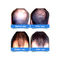 Tampões do crescimento do cabelo do laser do diodo 5mW da classe II para a queda de cabelo